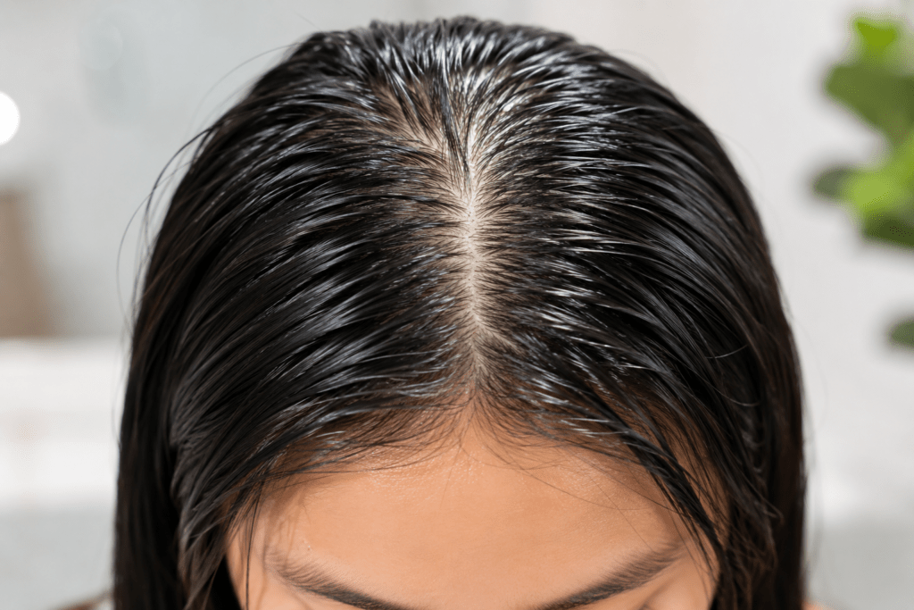 Close-up of an oily scalp with dark hair showing greasy, shiny roots along the center part. Close-up of an oily scalp with dark hair showing greasy, shiny roots along the center part.