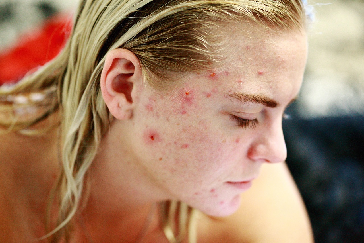 struggle, acne, self love, skin, face, portrait, woman, people, reality, girl, female, model, hair, person, human, skincare, character, caucasian, blemishes, pimples, no make up, life, problems, issues, self esteem, brown love, brown life, brown model, brown hair, brown human, acne, acne, acne, acne, acne, pimples, pimples