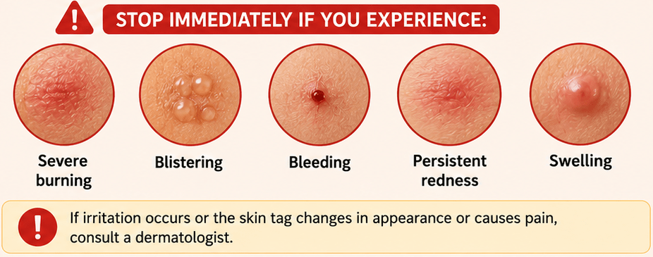 Stop immediately if you experience: Severe burning Blistering Bleeding Persistent redness Swelling