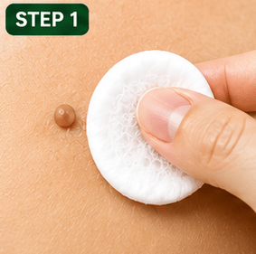 Step 1: Clean the skin tag