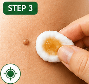 Step 3: Place the soaked cotton directly on the skin tag. 