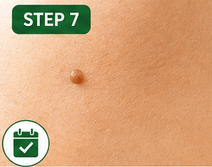 Step 7: Repeat once daily until the skin tag shrinks or falls off.
